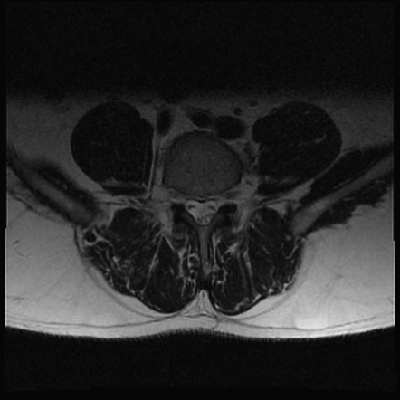 Bilateral L2 spondylolysis | Image | Radiopaedia.org