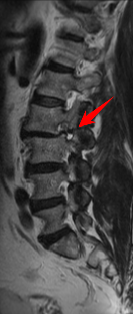 Bilateral L2 spondylolysis | Image | Radiopaedia.org