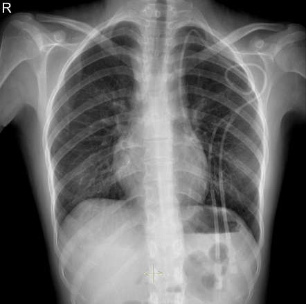 Persistent left superior vena cava | Radiology Case | Radiopaedia.org