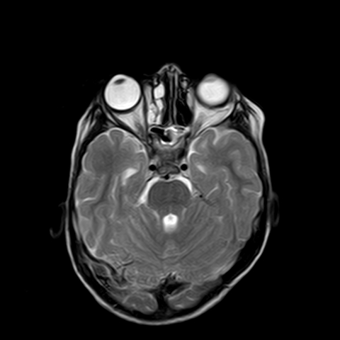 Post traumatic fracture of the cribriform plate and right frontal ...