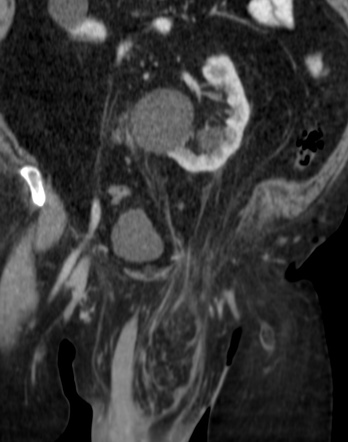 Nephroptosis with inguinal hernia containing perirenal fat | Radiology ...