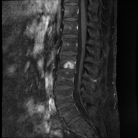 Schmorl node - acute | Image | Radiopaedia.org