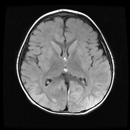 Posterior Reversible Encephalopathy Syndrome (pres) In A Toddler 