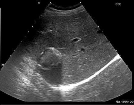 Calcified hydatid liver cyst | Radiology Case | Radiopaedia.org