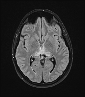 Rosette-forming glioneural tumor | Image | Radiopaedia.org