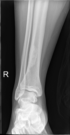 Ossifying Fibroma Tibia