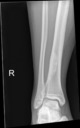 Leave alone lesions - skeletal | Radiology Reference Article ...