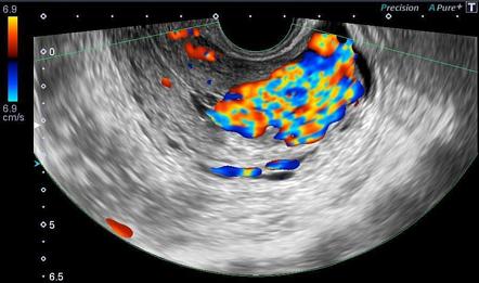 Arteriovenous Malformation Of The Uterus Associated With Secondary | My ...