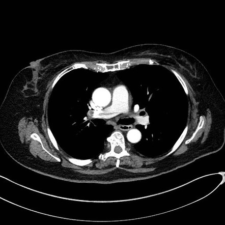 Saddle pulmonary embolism | Radiology Case | Radiopaedia.org