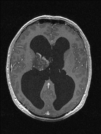 Central neurocytoma | Image | Radiopaedia.org