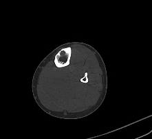 Metastatic alveolar soft tissue sarcoma | Image | Radiopaedia.org