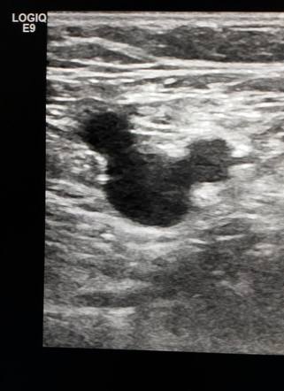 Mickey Mouse sign (ultrasound) | Radiology Reference Article