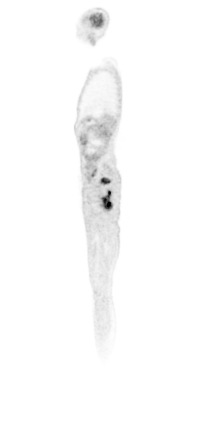 Solitary plasmacytoma of the bone | Image | Radiopaedia.org