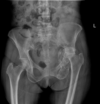 Solitary plasmacytoma of the bone | Radiology Case | Radiopaedia.org