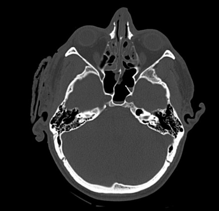 Traumatic Brain Injury With Depressed Skull Fracture | Image ...