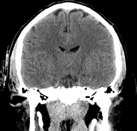 Traumatic brain injury with depressed skull fracture | Image ...