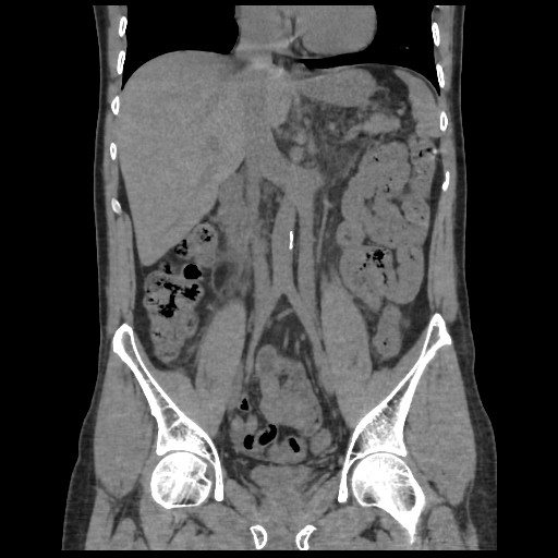 Inferior vena cava duplication | Image | Radiopaedia.org