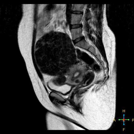 Subserosal leiomyoma of the uterus | Radiology Reference Article ...