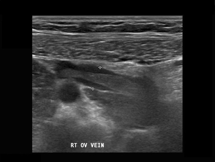 Ovarian Vein Thrombosis Radiology Case Radiopaedia Org