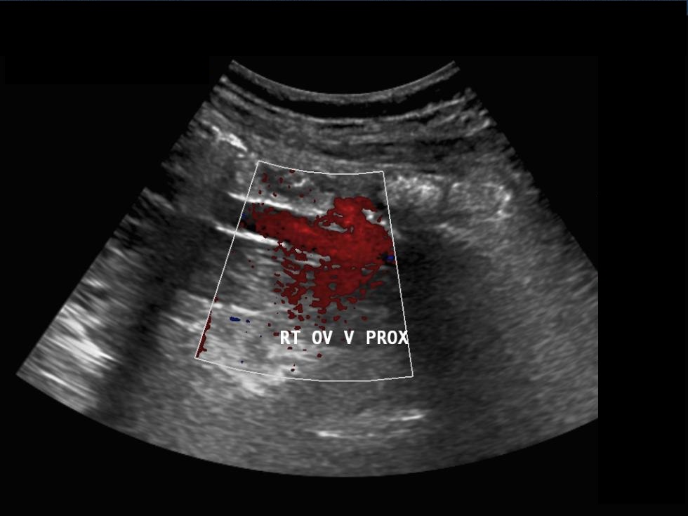 Ovarian Vein Thrombosis Image