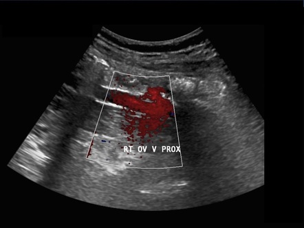 Ovarian vein thrombosis | Image | Radiopaedia.org