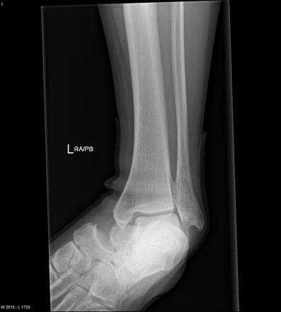 Subtalar dislocation | Radiology Case | Radiopaedia.org