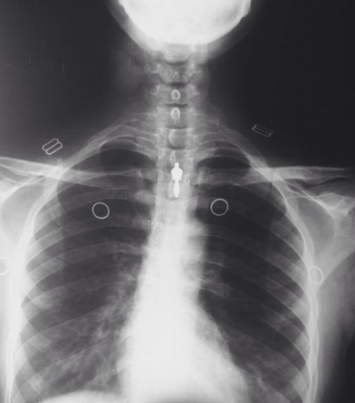 Cervical rib | Radiology Case | Radiopaedia.org