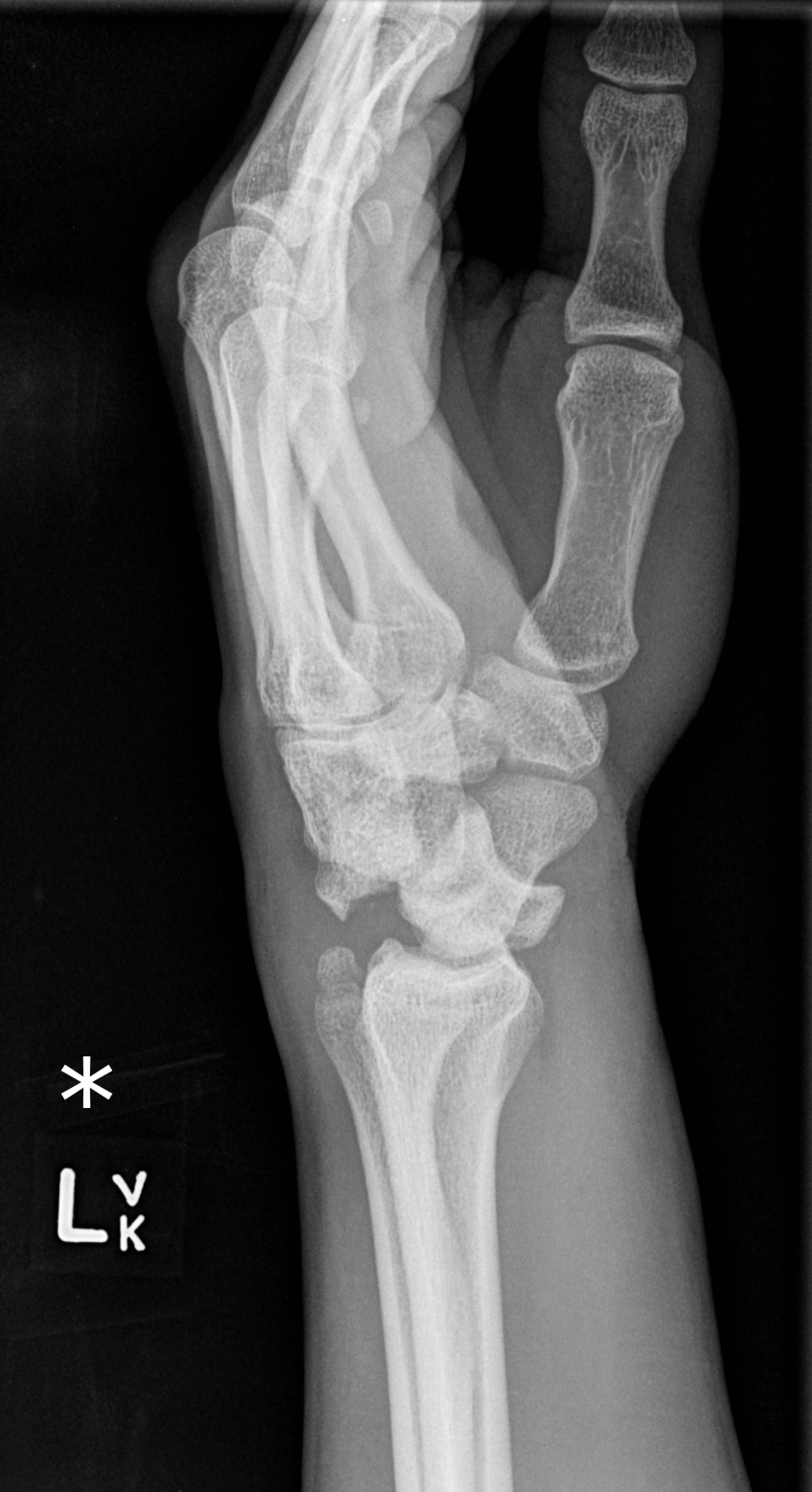 Transtriquetral perilunate dislocation | Image ...