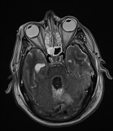 Terson Syndrome | Radiology Case | Radiopaedia.org