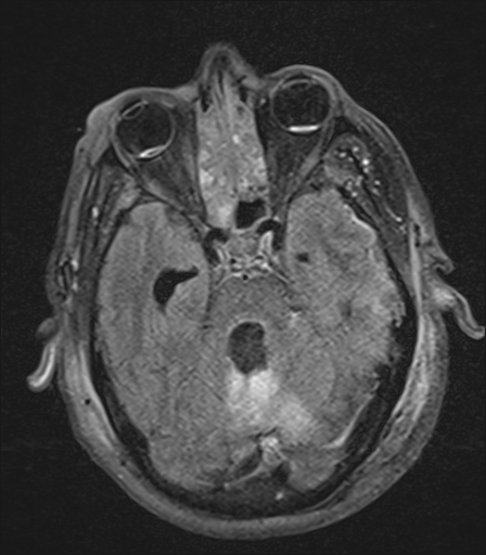 Terson syndrome | Image | Radiopaedia.org