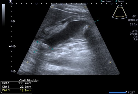 Gangrenous Cholecystitis | Radiology Case | Radiopaedia.org