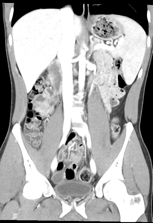 Enteritis with small bowel intussusceptions | Image | Radiopaedia.org