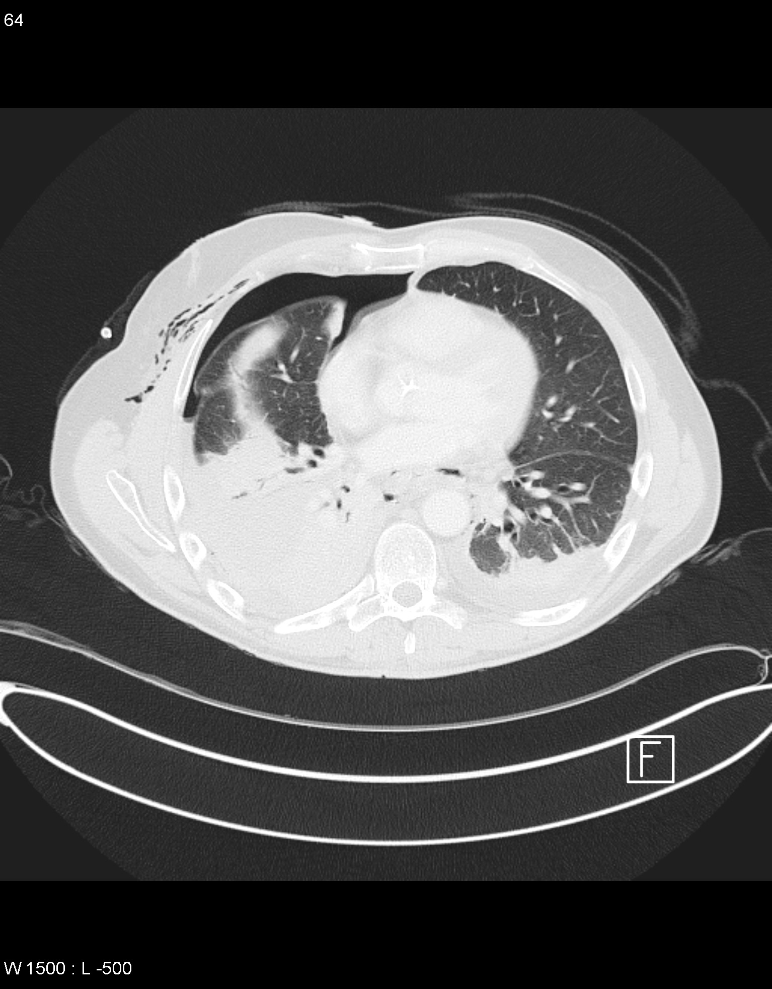 Boerhaave Syndrome With Tension Pneumothorax Image Radiopaedia Org