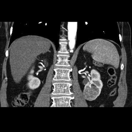 Renal Tumors Radiology Reference Article Radiopaedia Org