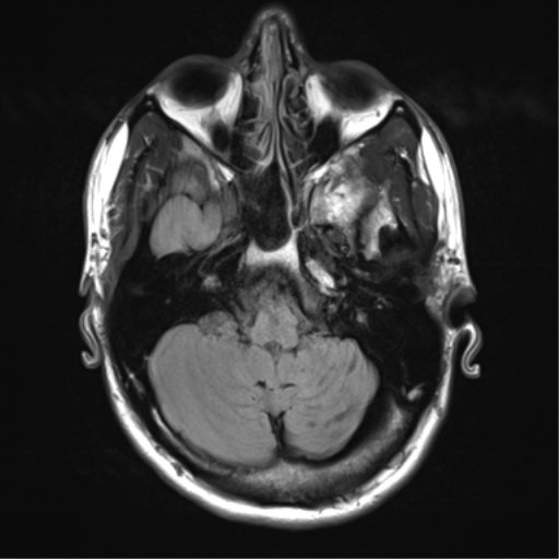 Developmental Venous Anomaly: Cerebellar Atrophy And Dystrophic 