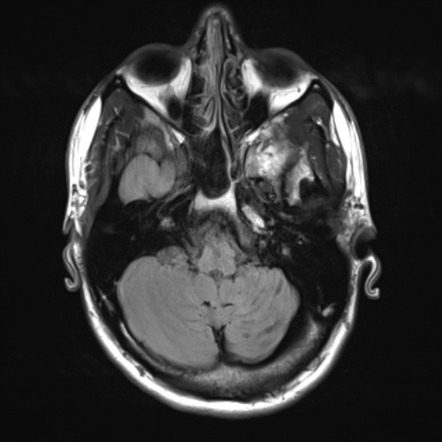 Developmental venous anomaly: cerebellar atrophy and dystrophic ...