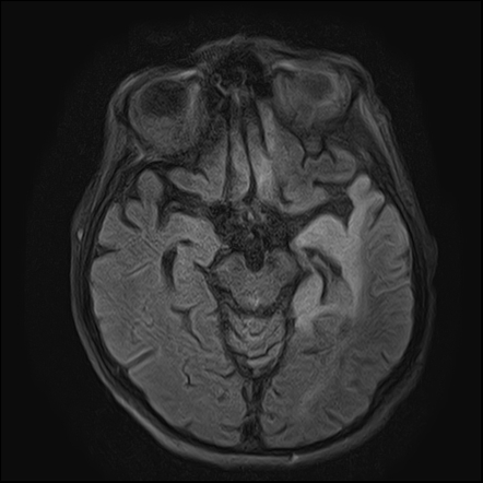 simplex herpes encephalitis virus radiopaedia