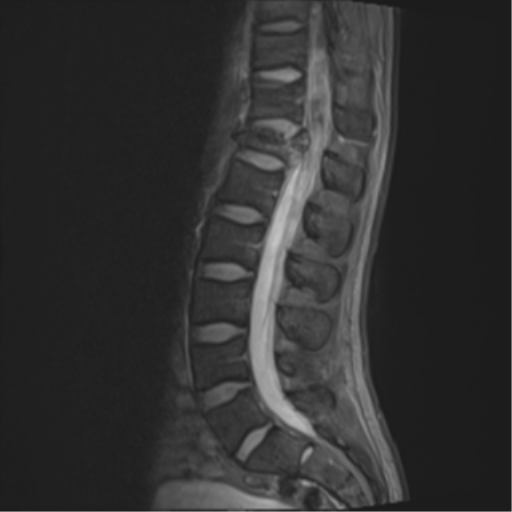 Burst fracture - T12 with conus compression | Image | Radiopaedia.org