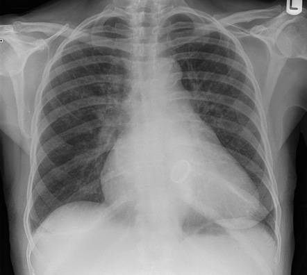 Mitral valve replacement | Radiology Reference Article | Radiopaedia.org