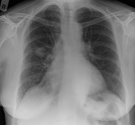 Coin lesion (lung) | Radiology Reference Article | Radiopaedia.org