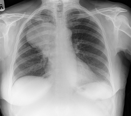 Lung cancer - hilum overlay sign | Radiology Case | Radiopaedia.org