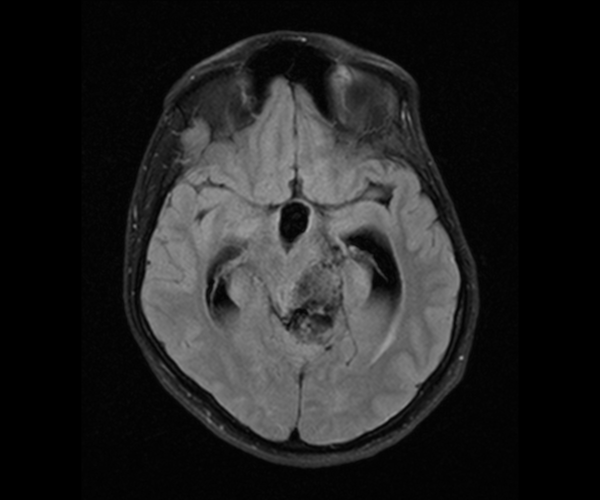 Cerebellopontine Angle Epidermoid Cyst Image 5095