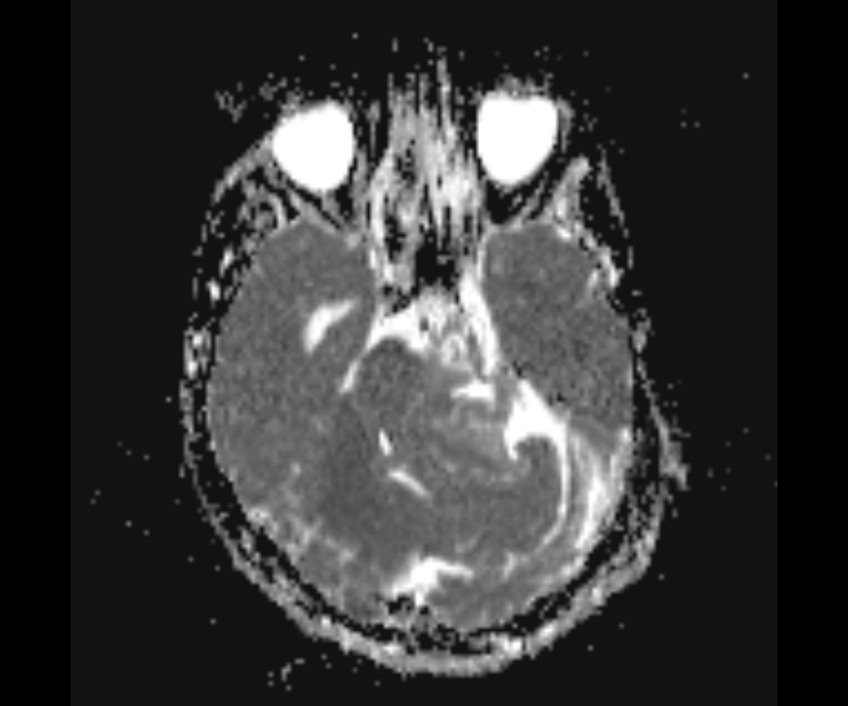 Cerebellopontine Angle Epidermoid Cyst Image 0076