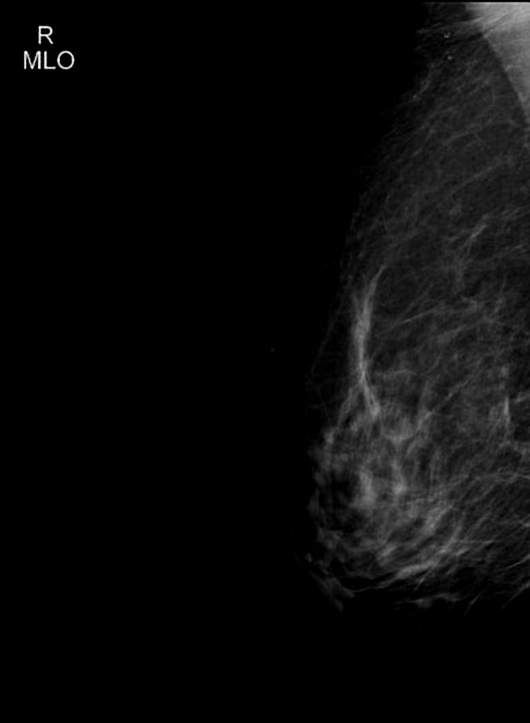 Invasive Ductal Carcinoma Nst Radiology Case Radiopaedia Org