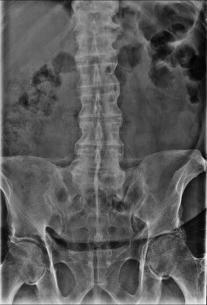 Diffuse Idiopathic Skeletal Hyperostosis 