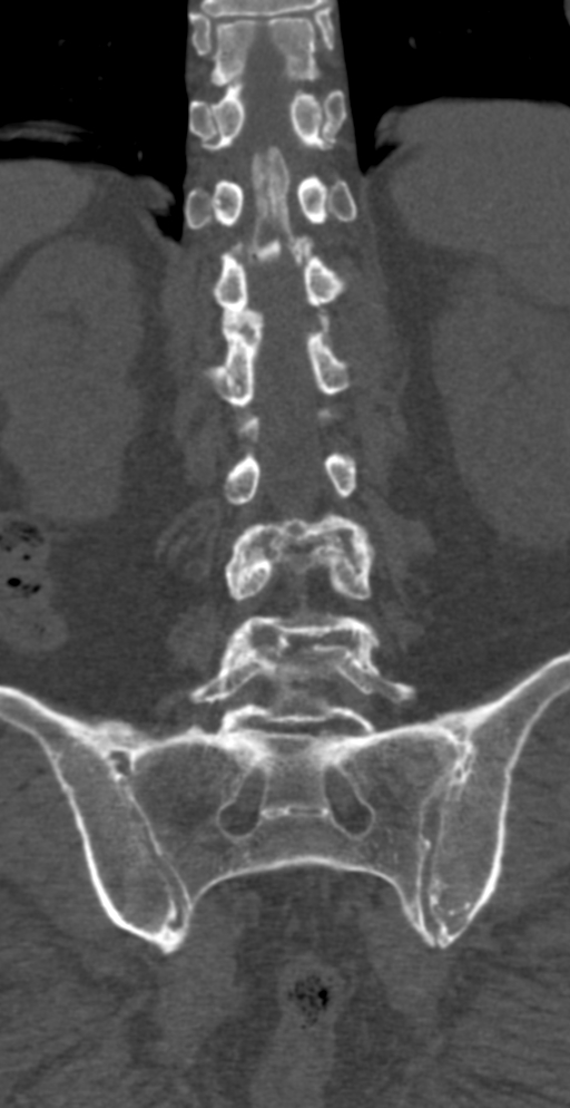 Diffuse idiopathic skeletal hyperostosis | Image | Radiopaedia.org