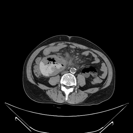 Small bowel lymphoma | Radiology Case | Radiopaedia.org