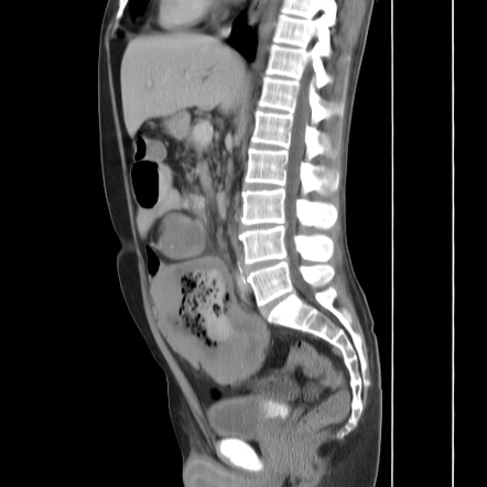 Small bowel lymphoma | Image | Radiopaedia.org