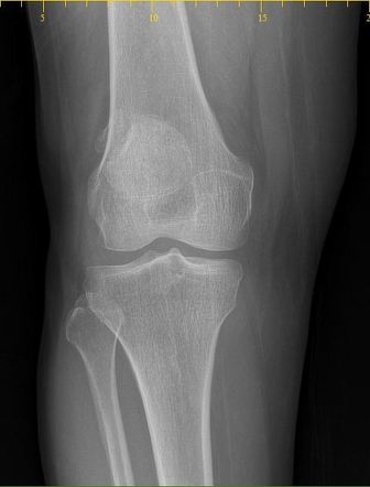 Bipartite patella | Radiology Reference Article | Radiopaedia.org