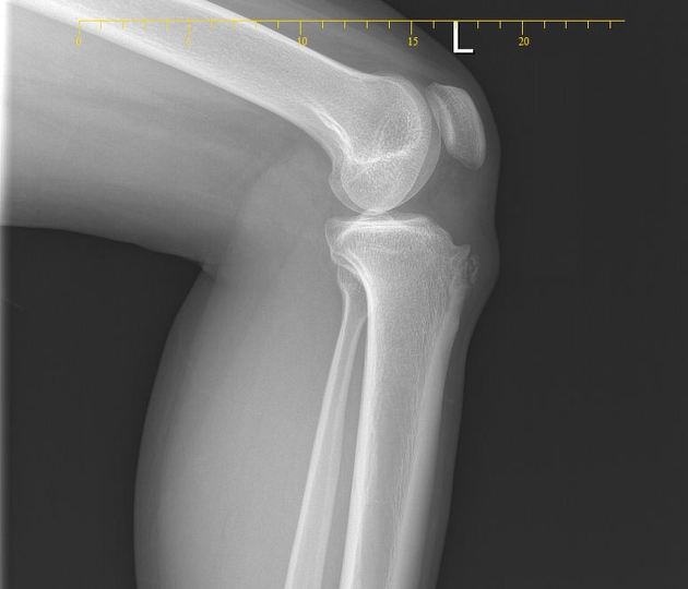 Osgood-Schlatter disease | Radiology Reference Article | Radiopaedia.org